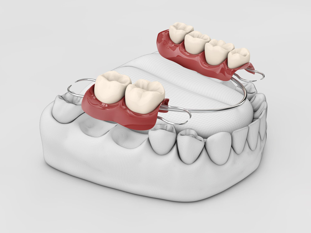 Dental Bridges