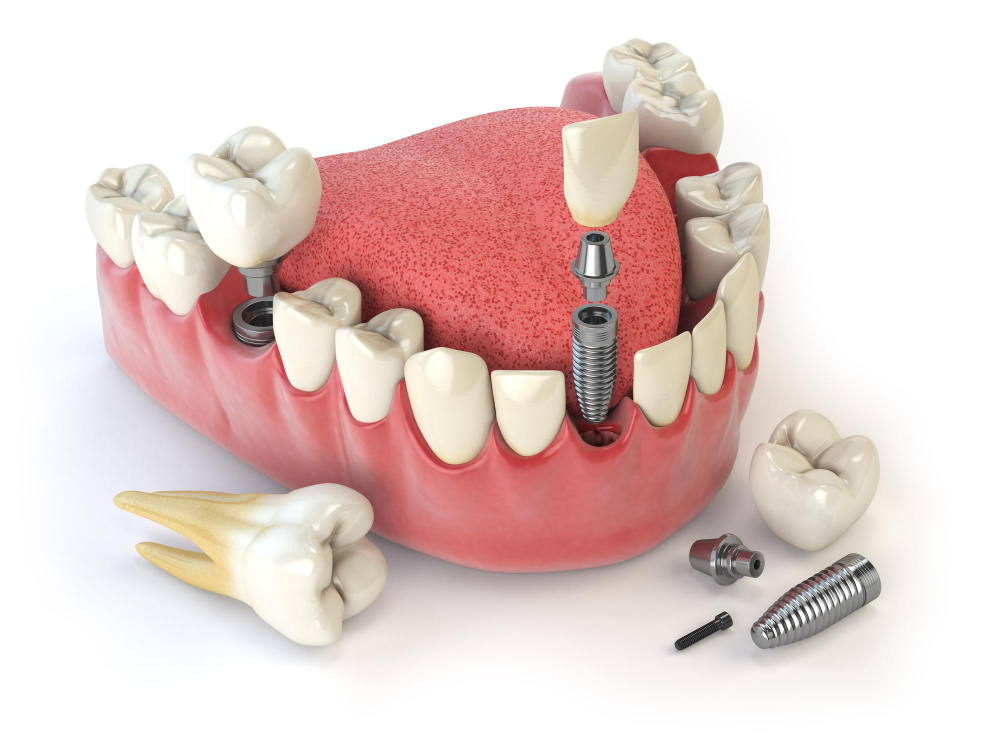 Tooth Implants